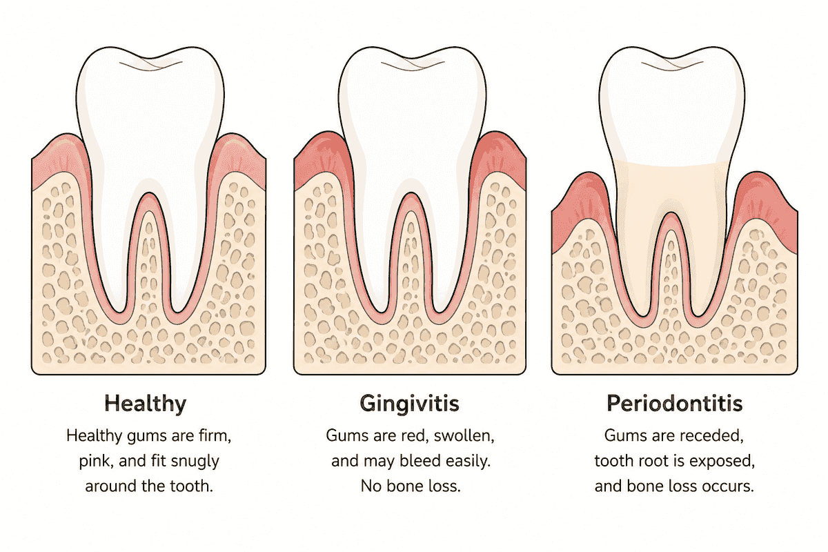 Side-by-side cross-section diagram comparing healthy gum tissue, gingivitis (red, swollen, still attached), and periodontitis (receded gum, exposed root, bone loss)