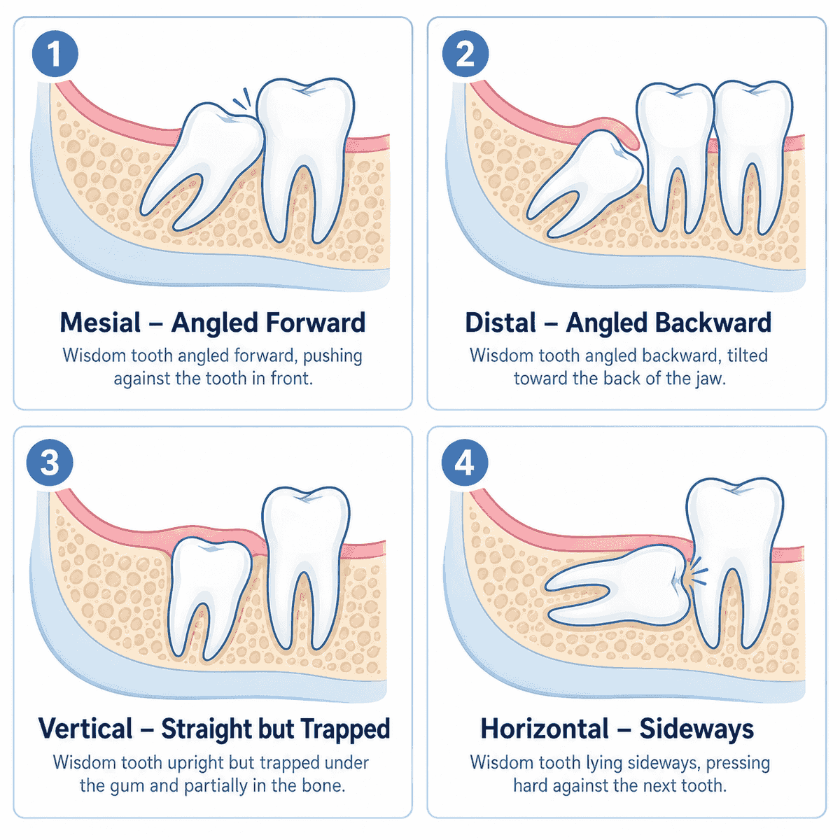 Diagram showing four types of wisdom tooth impaction: mesial (angled forward, pushing against the front tooth), distal (angled backward, tilted toward the back of the jaw), vertical (upright but trapped under the gum and bone), and horizontal (lying sideways, pressing hard against the next tooth)